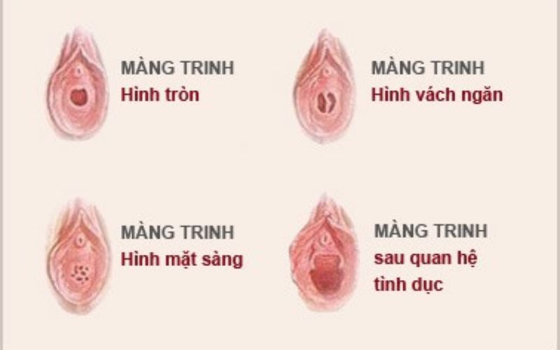 các dạng màng trinh