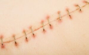 sẹo tầng sinh môn