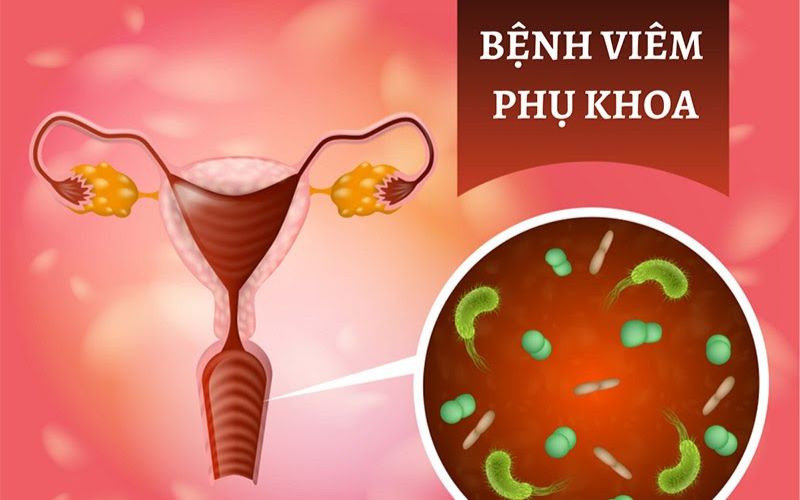 viêm nhiễm phụ khoa Vkin Clinic 1
