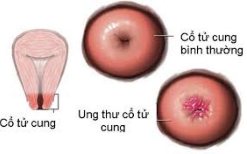 ung thư cổ tử cung Vkin 1