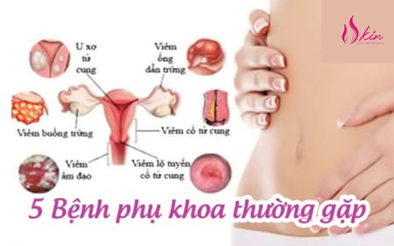 viêm nhiễm phụ khoa 2