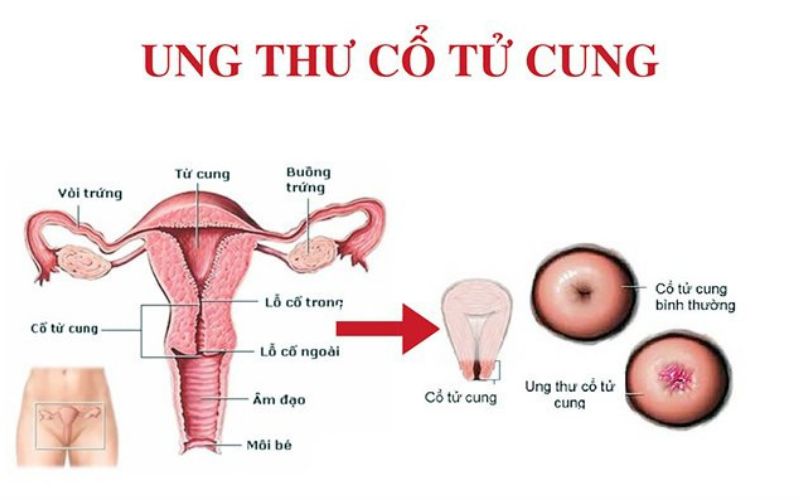 ung thư cổ tử cung Vkin 2