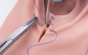 nâng sa trễ tầng sinh môn