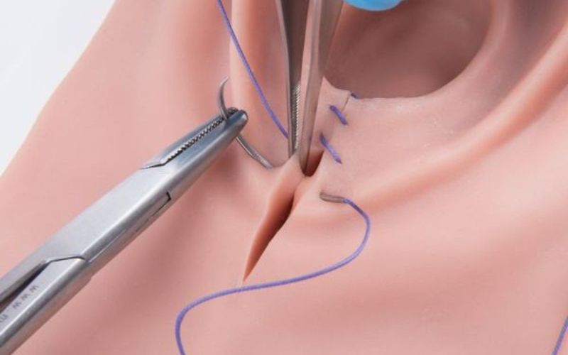 nâng sa trễ tầng sinh môn