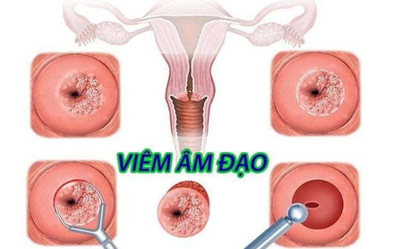 bệnh phụ khoa viêm âm đạo