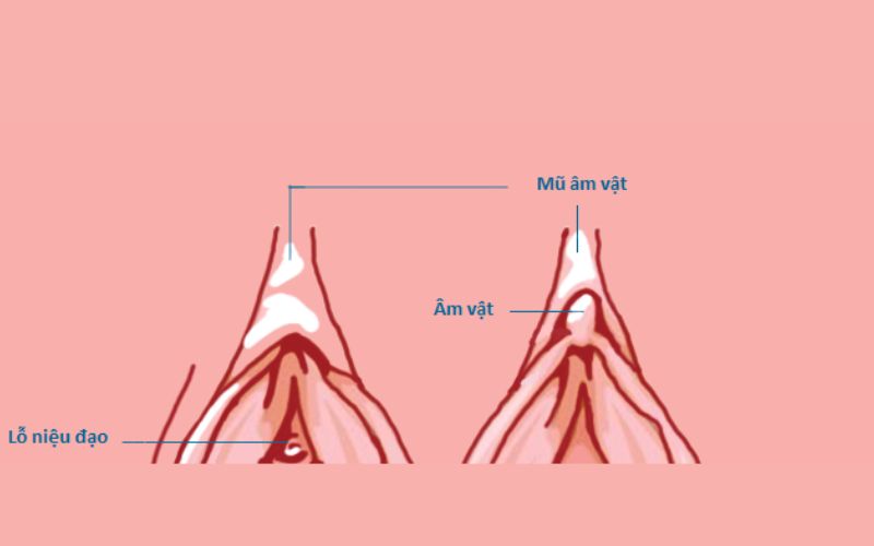 tạo hình mũ âm vật Vkin Clinic 1